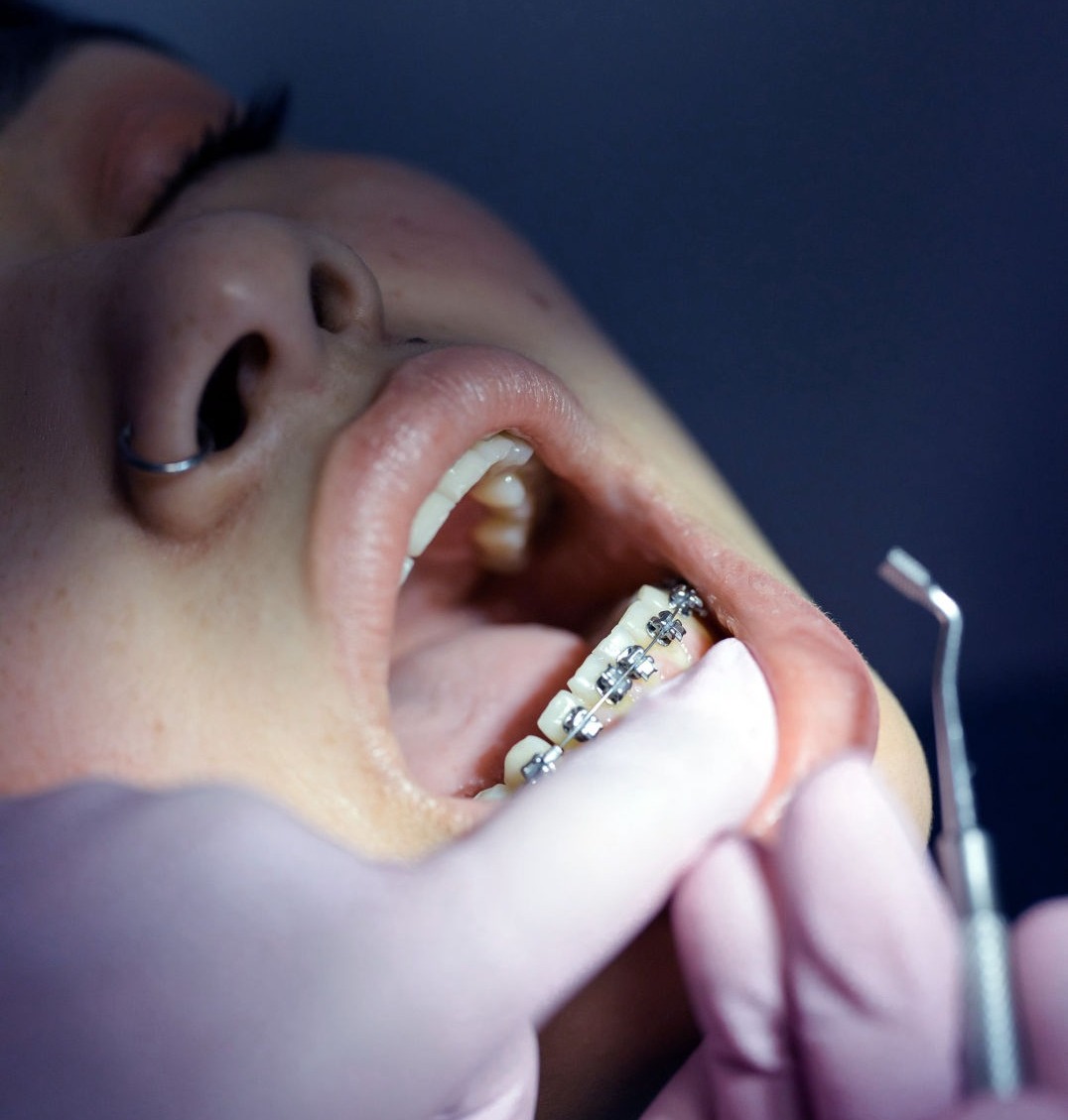 Comfy Dental Los Angeles Dentist Orthodontic Treatment