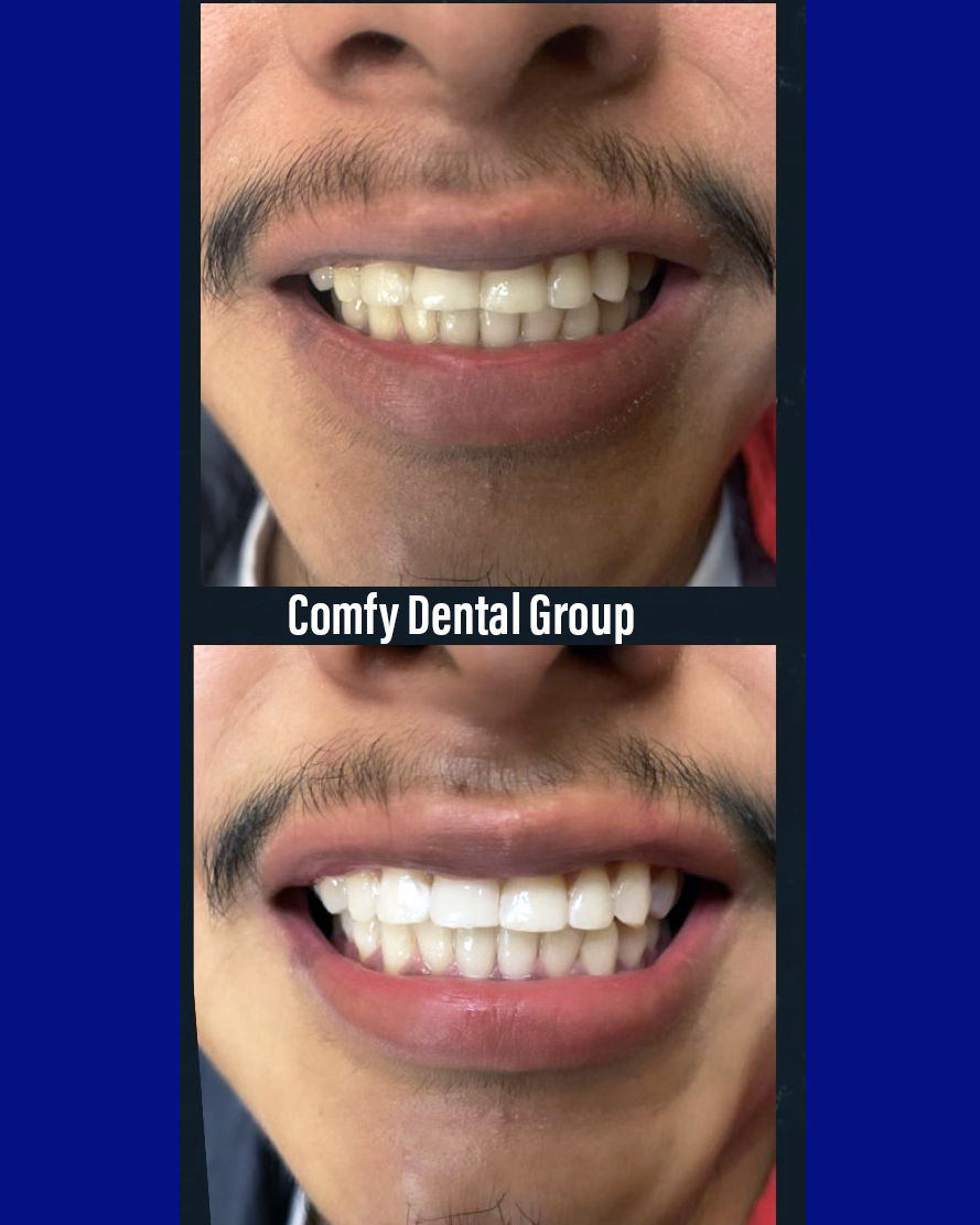 Comfy Dental Simi Valley Dentist orthodontic Fixed appliances