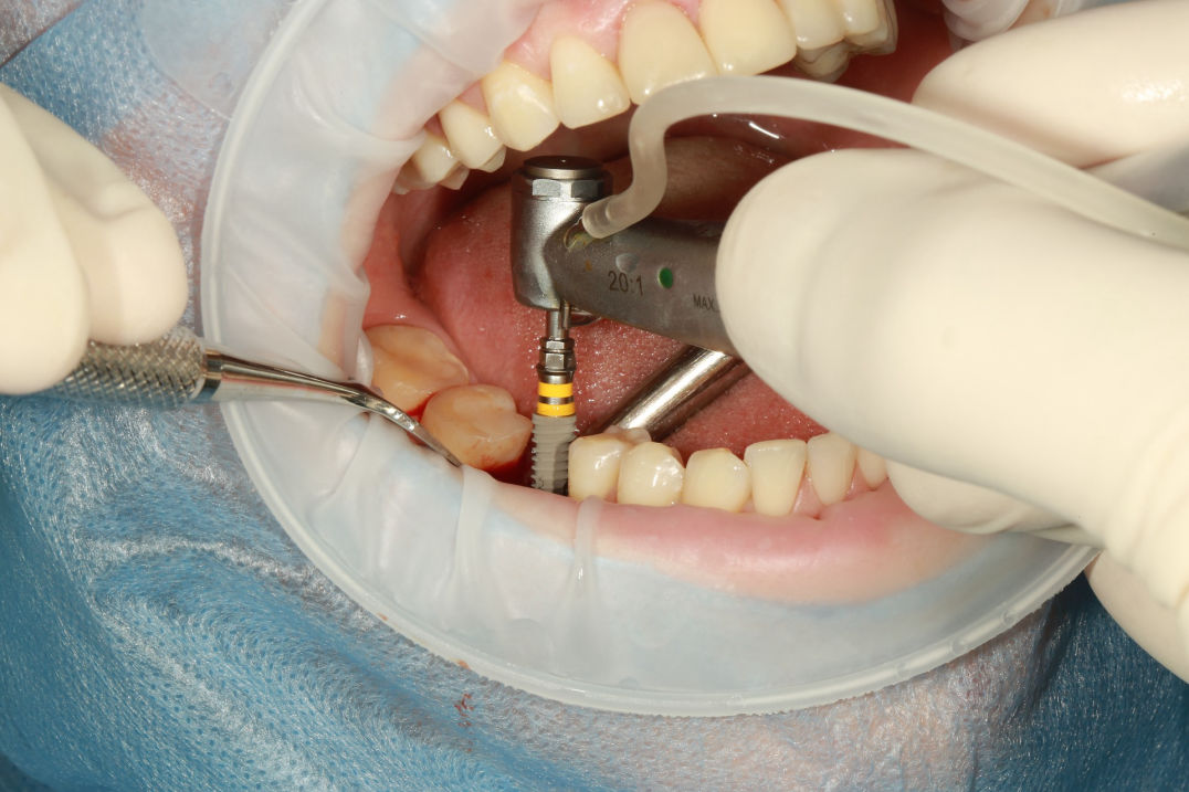 Comfy Dental implants